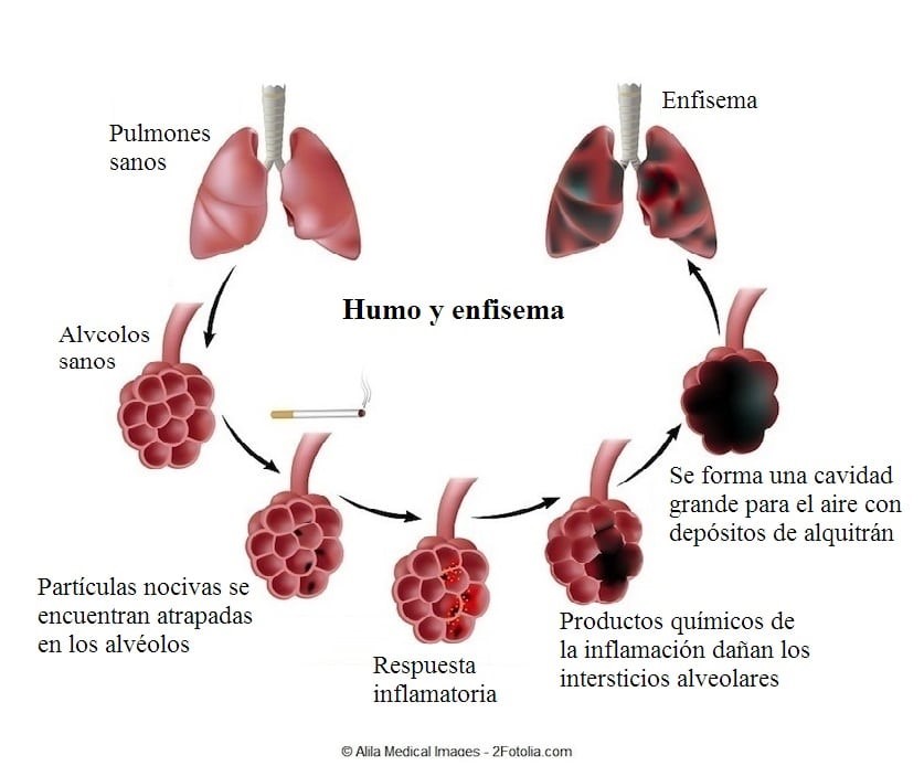 Imagen: www.fisioterapiaparatodos.com